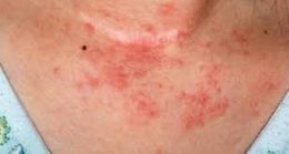 Dermatitis por medicamentos.jpg