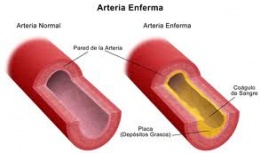Enfermedad Arterial Periférica1.jpeg