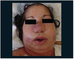 Rinoscleroma.jpg