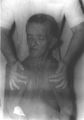 Mustelier, Chang, Almunia y Molero - Disostosis cleidocraneal en Revista Cubana de Medicina (1999).jpg