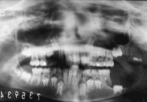 Quiste dentígero.JPG