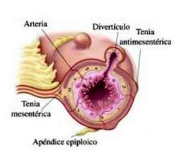 Enfermedad diverticular colon.jpg