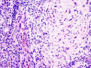 Adenoma pleomorfo new.jpeg