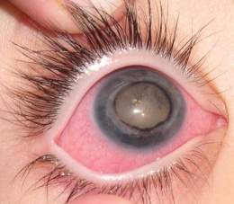 E Corneal.jpg