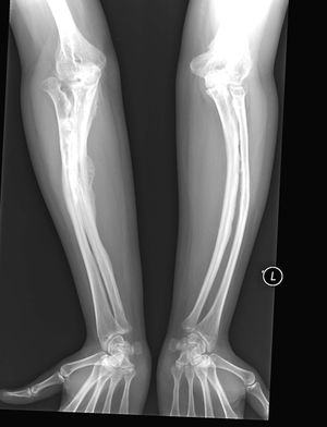 Osteogenesis imperfecta.jpg