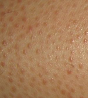 Queratosis pilar.jpeg