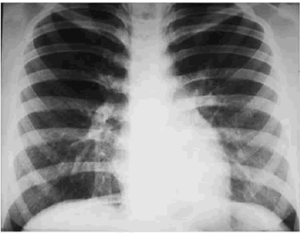 Edema-pulmonar-13f1b.gif