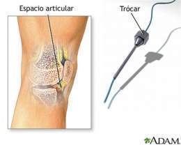 Artritis fúngica o micótica (Small).jpg
