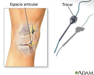 Artritis fúngica o micótica (Small).jpg