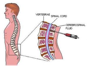 Sindrome Guillain Baree.JPG