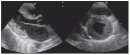 Amiloidosis cardíaca.gif