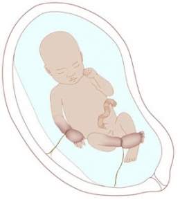 Sindrome prenatal1.jpg