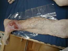 Ulceras varicosas.jpg