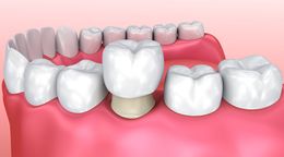 Coronas-puentes-porcelana.jpg