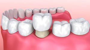 Coronas-puentes-porcelana.jpg