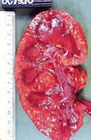 Pielonefritis-aguda 817 (Small).jpg