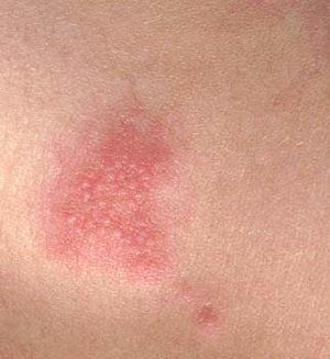 Herpes-zoster-2.jpg