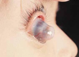 Estafiloma corneal.JPG
