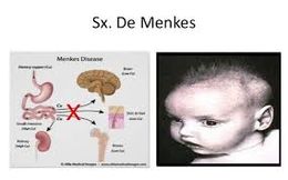 Síndrome de Menkes.jpg
