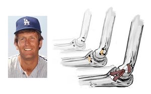 Operacion-tommy-john.jpg