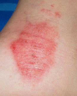 Dermatitis fotoalérgica.nfvgnf25jpg.jpeg