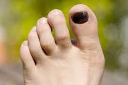 Hematoma Subungueal.jpg