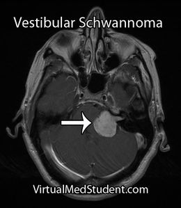 Schwannoma.jpg