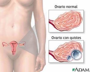 Quistes-ováricos2 .jpg