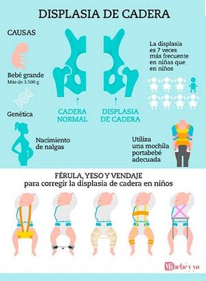Displasia-cadera-info.jpg