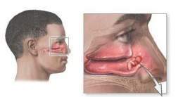 Cancer nasal.jpg