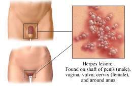 Genital herpes lesion.jpg