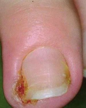 Uña encarnada mano.jpg