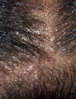 Impetigo 100801.jpg