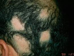 Alopecia areata.jpg