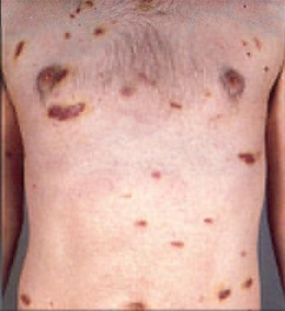 Foto de Sarcoma de Kaposi.JPG