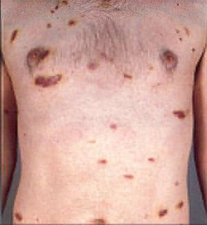 Foto de Sarcoma de Kaposi.JPG