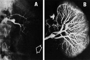 Sx hepatorrenal.jpg