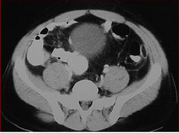 Apendicitis epiploica.jpg
