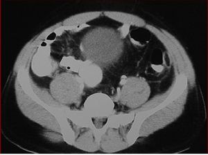 Apendicitis epiploica.jpg