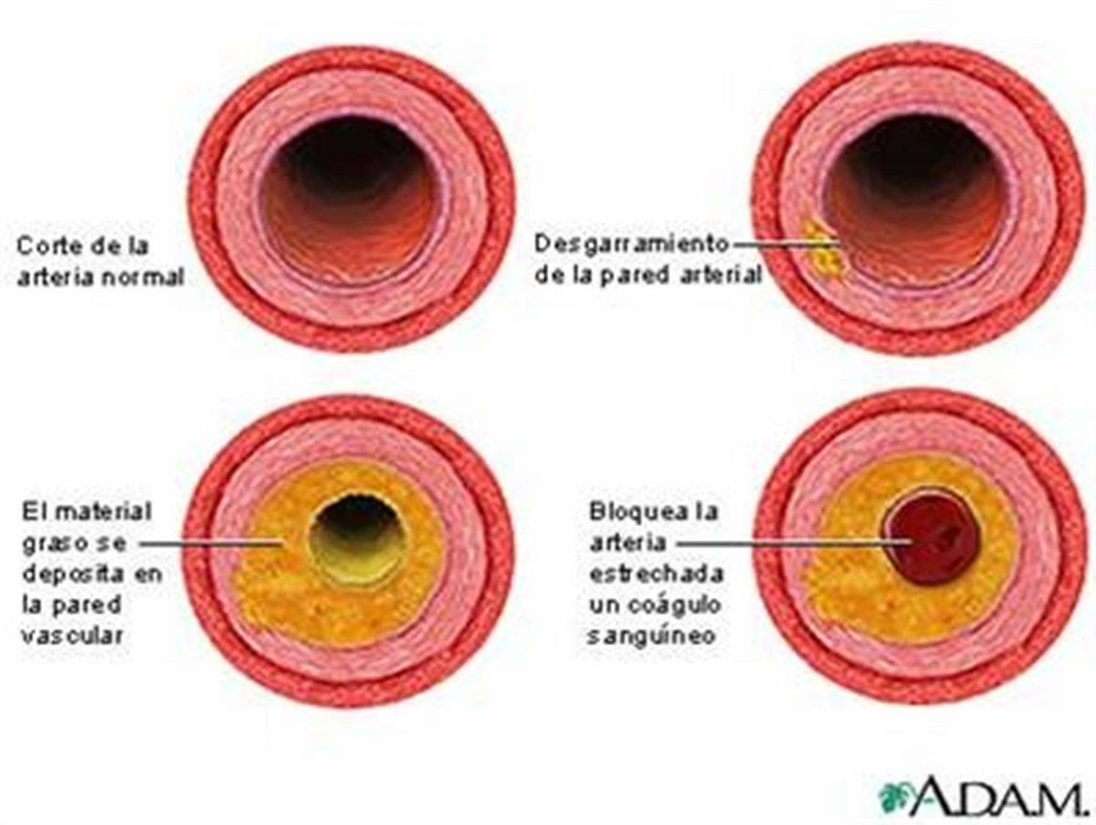 Cardiopatía coronaria EcuRed