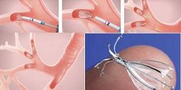 Valvulas endobronquiales.jpg