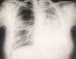 Carcinoma broncoalveolar.jpg