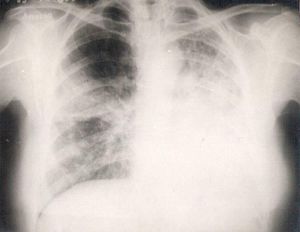 Carcinoma broncoalveolar.jpg