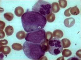 Leucemia mielocítica crónica.jpg