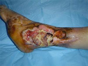 Marjolin's-ulcer.jpg