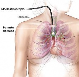 Mediastinoscopia.JPG
