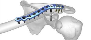 PLACA DE CLAVICULA DISTAL.jpg