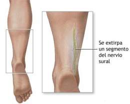 Biopsia de nervio.jpg