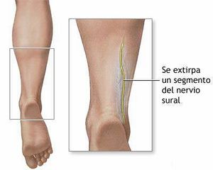 Biopsia de nervio.jpg