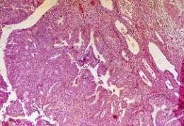 Adenocarcinoma solido2.jpg